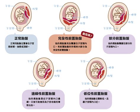 前置胎盤剝離|馬偕紀念醫院 衛教單張：前置胎盤